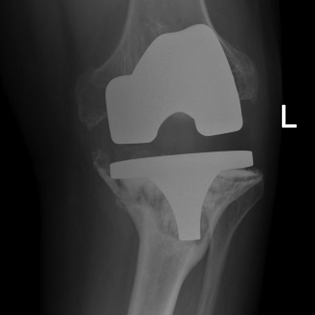 Revision TKR Severe Loss Tibial Bone Stock